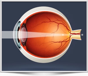 Чебоксары глазная клиника федорова смешанный астигматизм лечение