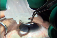 Сколько стоит удаления катаракты в саратове на вольской 15 лазером