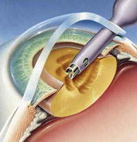 Стоимость операции катаракты в нии