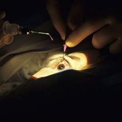 Лечение катаракты в воронежской областной глазной больнице