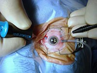 Операция на глаз в александрове